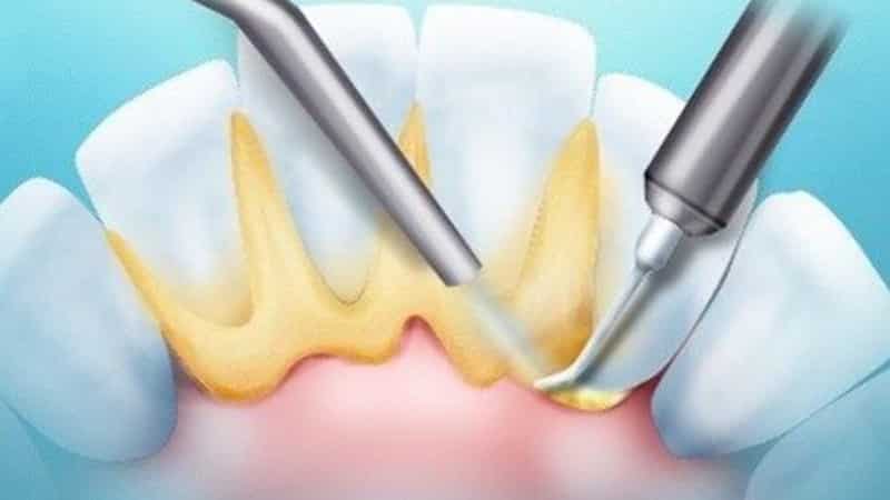 Имплантация зубов