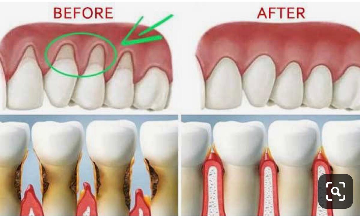 вживление имплантата