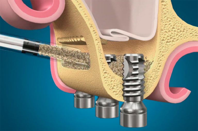 Синус-лифтинг