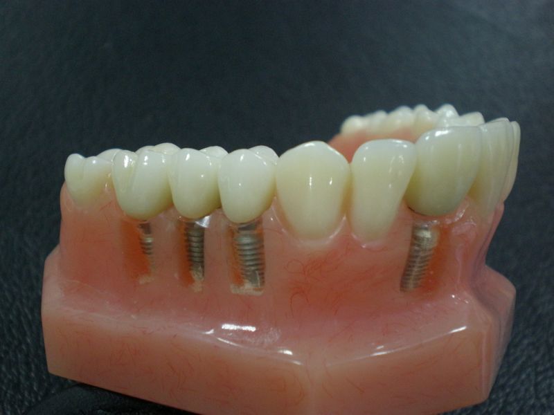 протезирование передних зубов